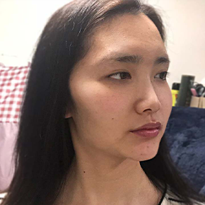 3D CT Rhinoplasty before