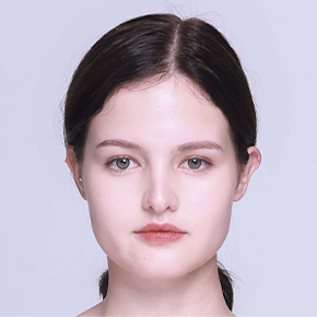 Revision Rhinoplasty before