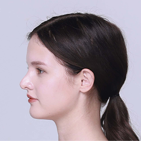 Revision Rhinoplasty before