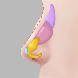 Surgical dissection separating cartilage, perichondrium, nasal bone, and periosteum to create space for implant placement