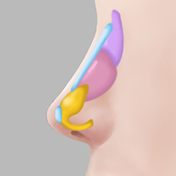 Insertion of cartilage and implant materials tailored to the nasal bridge and tip during rhinoplasty
