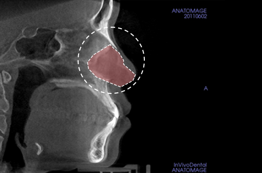 Analysis of septal cartilage in various sizes and shapes