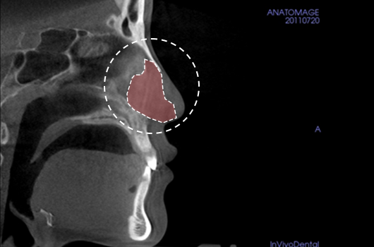 Analysis of septal cartilage in various sizes and shapes