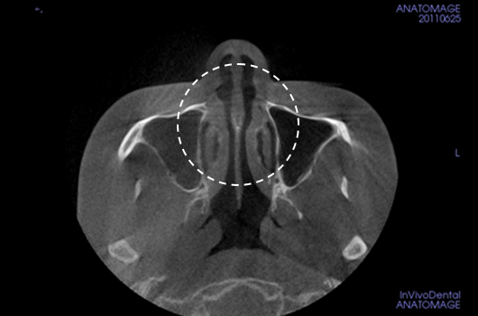 Diagnosis of deviated nose and septal deviation