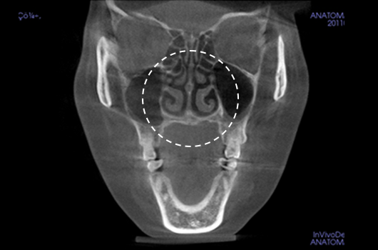 Diagnosis of deviated nose and septal deviation