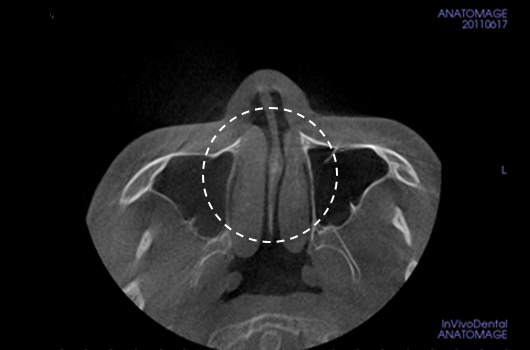 Analysis of the width and asymmetry of the nasal bone
