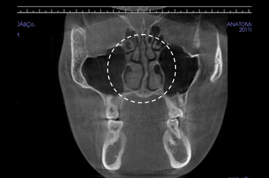 Analysis of the width and asymmetry of the nasal bone