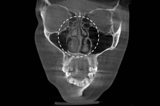 Diagnosis of inferior turbinate asymmetry and surgery for nasal obstruction