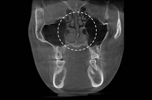 Diagnosis of inferior turbinate asymmetry and surgery for nasal obstruction