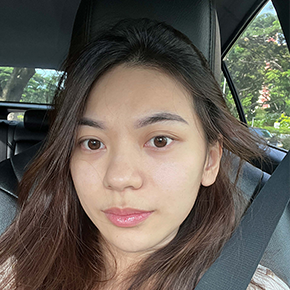 Double Eyelid Surgery before