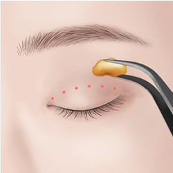 Removing excess fat through small upper eyelid incisions to create natural adhesion between skin and levator muscles
