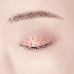 Using a surgical thread to connect the inner and outer parts of the eyelid during double eyelid procedure