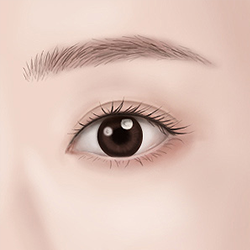 Achieving natural-looking eyes with minimal visible scarring after a double eyelid procedure