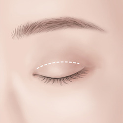Designing an eyelid crease with ideal height and shape to suit facial proportions