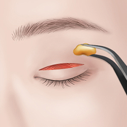 After incision, removing excess fat and muscle as needed during eyelid surgery