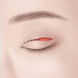 Using a surgical thread to connect the inner and outer parts of the eyelid during eyelid surgery