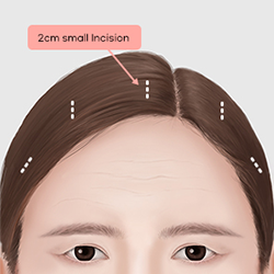 Making three to five small incisions inside the hairline to minimize visible scarring during surgery
