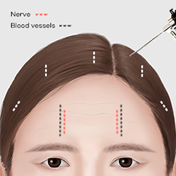 Using a full HD endoscope to identify nerves and blood vessels before gentle forehead dissection