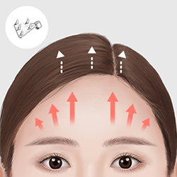 Placing and securing an endotine in the deep fascia or skull to lift and stabilize the forehead