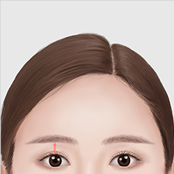 Improving wrinkles between the brows, around the eyes, and on the eyelids to achieve a more youthful appearance