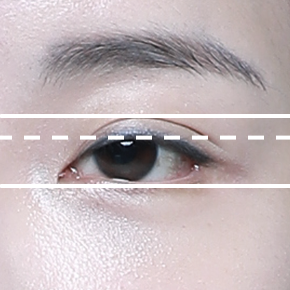 Ptosis Correction before