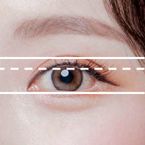 Ptosis Correction after