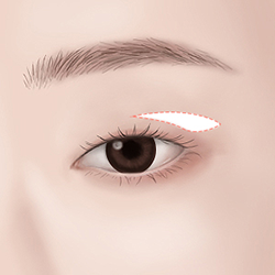 Surgical design planned immediately before surgery following a doctor’s consultation