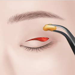 Creating a double eyelid crease at the desired height after removing excess skin and fat