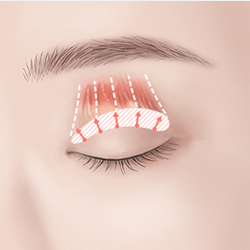 Pulling the levator muscle to suture and secure the eyelid crease during surgery