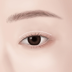 Surgical design planned immediately before surgery following a doctor’s consultation