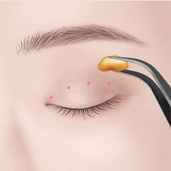 Creating a double eyelid crease at the desired height after removing excess fat