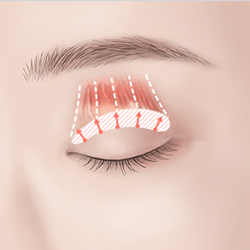 Creating an eyelid crease by forming natural adhesion between muscle and skin through 5 to 12 small openings during the procedure