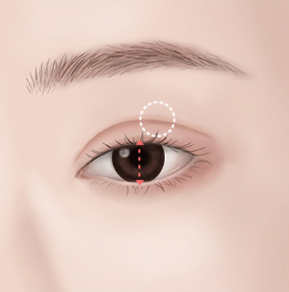 When only double eyelid surgery was performed