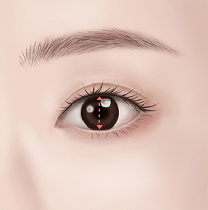 When combining double eyelid surgery and ptosis correction