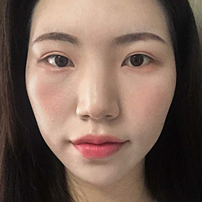 Non-incisional ptosis correction before