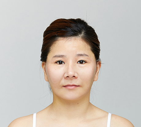 Anti-Aging Eye Surgery before