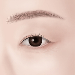 Marking and designing the eyes to assess the degree and cause of eyelid droopiness before surgery