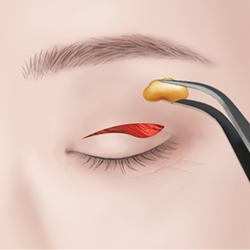 Making an incision along the marked eyelid crease to remove excess skin and fat