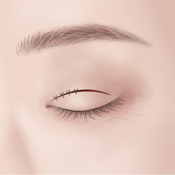 Connecting the incised eyelid skin to the levator muscle and securing it with sutures