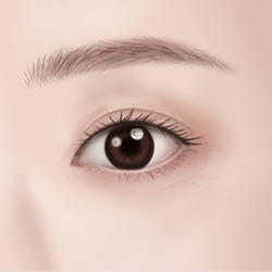 Achieving natural, clear, and youthful-looking eyes after eyelid surgery