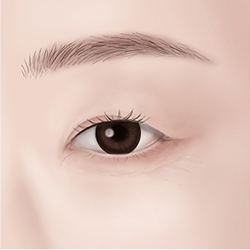 Marking and designing the eyes by identifying the cause and extent of eyelid drooping