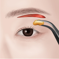 Making an incision along the marked eyelid crease to remove loose skin and excess fat