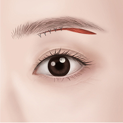 Firmly connecting the incised eyelid skin and securing it with sutures