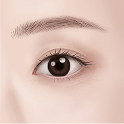 Achieving natural, clear, and youthful-looking eyes after eyelid surgery