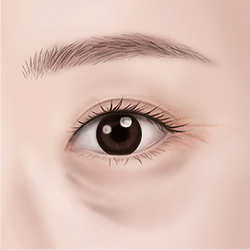 Marking and designing the eyes by identifying the cause and extent of drooping eyelids