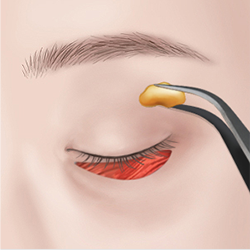 Making a discreet incision under the lower lashes and adjusting fat through the conjunctiva to minimize visible scarring