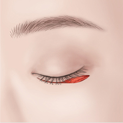 Suturing after attaching the muscle to the periosteum during eyelid surgery