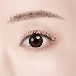Completing smooth under-eye appearance after lower eyelid surgery