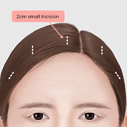 Making three to five small incisions inside the hairline to minimize visible scarring