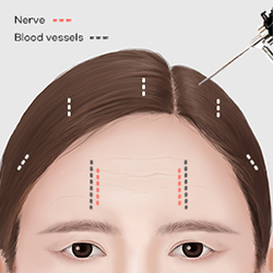 Using a full HD endoscope to confirm nerve and blood vessel positions before gently dissecting the sagging forehead